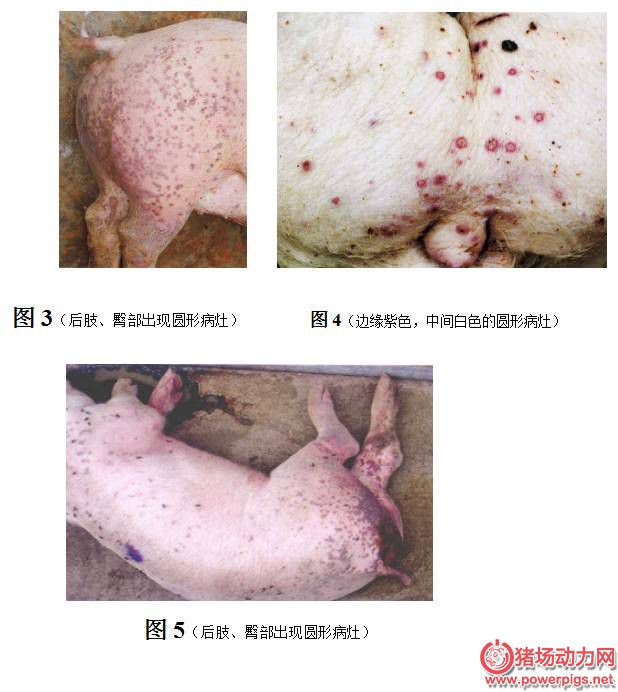 l 典型性的,皮炎肾病综合症